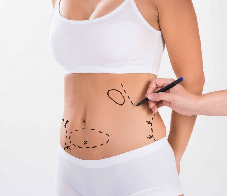 Expectations after Liposuction Surgery