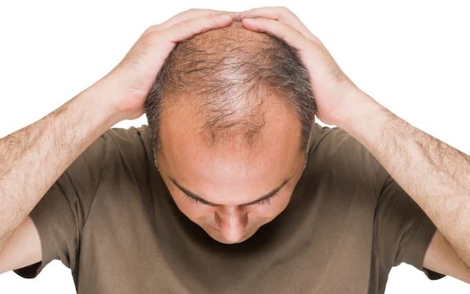 Hair Loss Treatment for Men